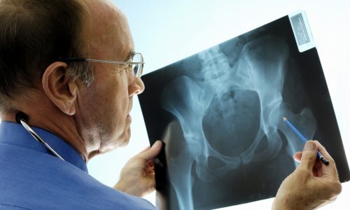 Orthopaedic surgeon consulting pelvic x-rays for a hip replacement. An experienced Caucasian orthopaedic surgeon (doctor) examining a pelvic x-ray displaying signs of osteoporosis - hip degeneration. Actual x-ray of a 42 year-old woman with a degenerative hip. The Orthopaedic surgeon is using a pencil to point at the hip where the problem is. This patient is a candidate (real) for hip replacement. The dominant colour is blue.